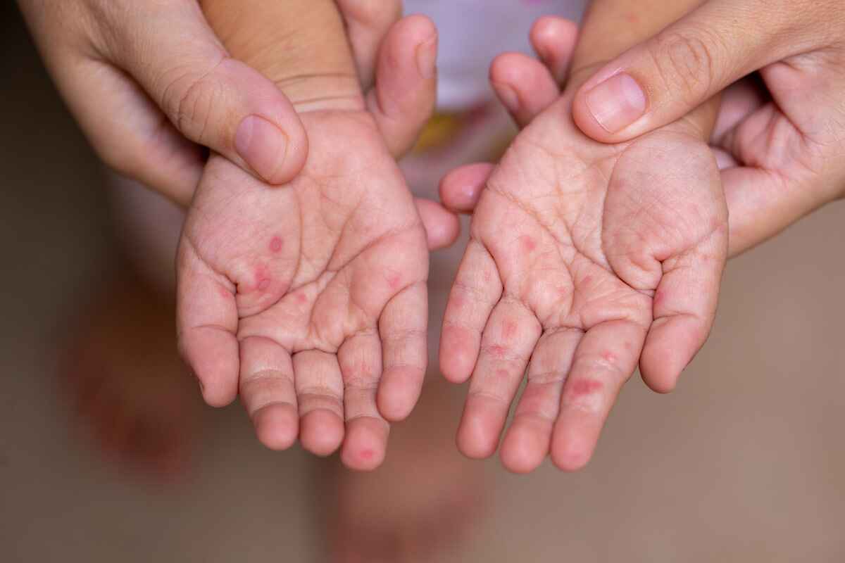 Photo of child with hand, foot and mouth disease